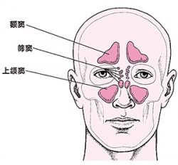 怎么治疗真菌性鼻窦炎？