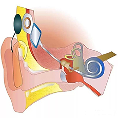 五例人工耳蜗手术在郑州民生耳鼻喉医院成功实施