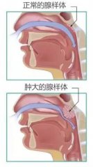 【儿童腺样体周末手术】预约开启！